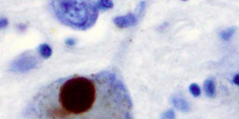 A Parkinson-kór (is) a belekben kezdődhet