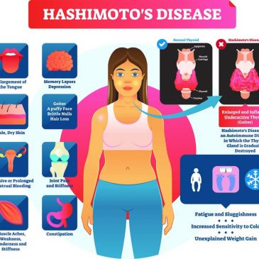 Hashimoto-val előzetesen diagnosztizált Hölgy “jobbulását” dokumentációja